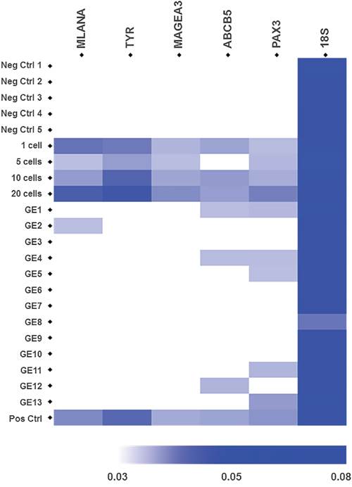 Gene expression of 5 melanoma-specific genes in samples from healthy controls, spiked samples and CTC fractions from metastatic melanoma patients after slanted enrichment.