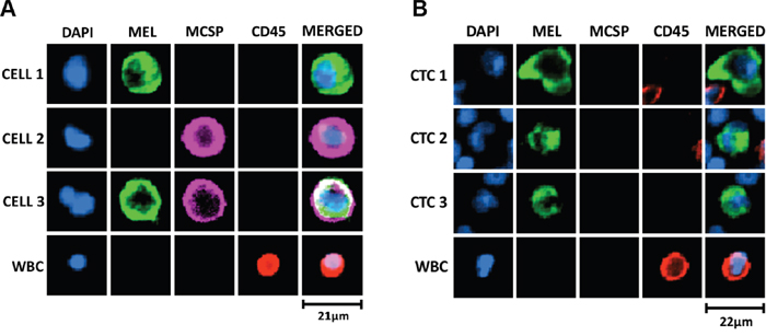 Melanoma-specific multimarker immunofluorescence staining for detection of melanoma CTCs.