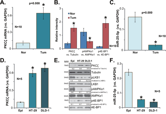 PKC&#x03B6; upregulation in human colon cancer tissues and CRC cells.