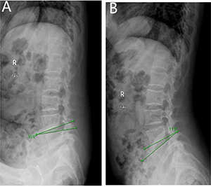Angular motion of a 48 years old man,diagnosed with discogenic low back pain (LBP) for 2 years.