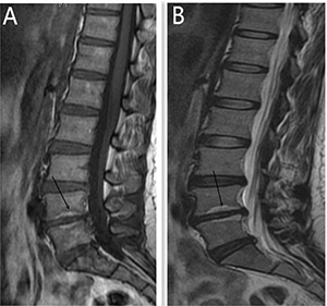 Modic type 2 changes was presented by MR for a 46 year old women, diagnosed with discogenic LBP for 10 months.