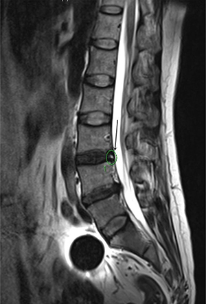 HIZ was presented by MR at the T2 signal (L3-4) for a 56 years old women, diagnosed with discogenic LBP for 3 years.