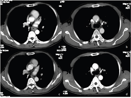 58 year-old man with good prognosis of esophageal squamous cell carcinoma.