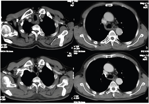 66 year-old man with poor prognosis of esophageal squamous cell carcinoma.