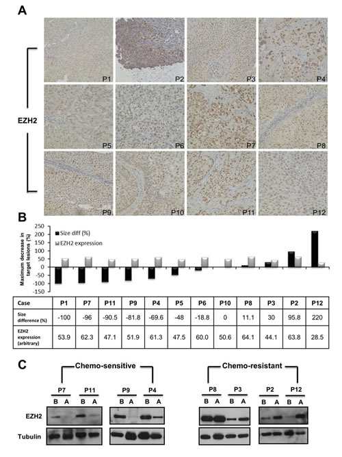 Down-regulation of EZH2 in bladder cancer tissues correlated with the therapeutic efficacy of neo-adjuvant chemotherapy.