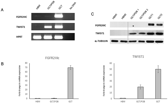 Differential expression of FGFR2IIIc and TWIST1 in GCT and GCT/PDB.