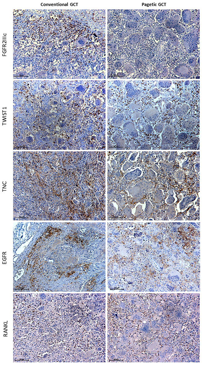 Histological comparison of the GCT markers between conventional and pagetic GCT.