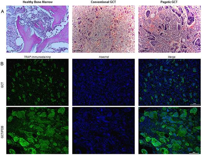 The different histological appearance of GCT and GCT/PDB tumor tissues.