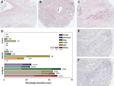 Immunoglobulin free light chains are expressed in breast, pancreas, lung, colon, skin and kidney cancer biopsies.