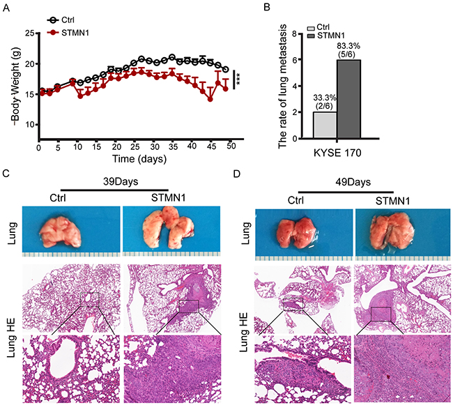 Stathmin overexpression increased ESCC cell lung metastasis in vivo.