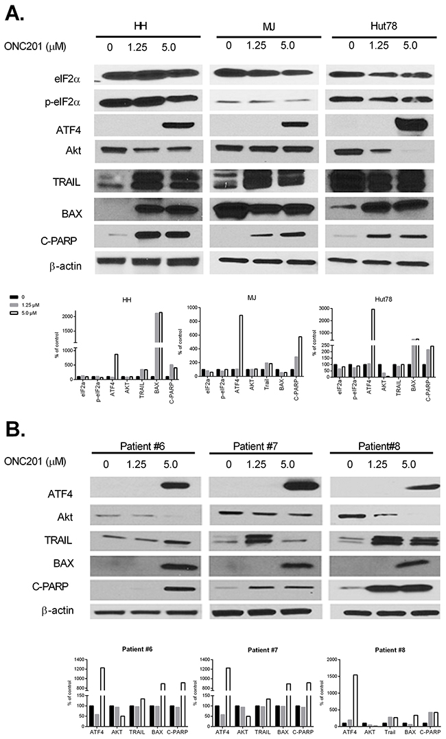 ONC201 upregulates ATF4, downregulates Akt, and induces TRAIL in CTCL cell lines and primary S&#x00E9;zary cells.