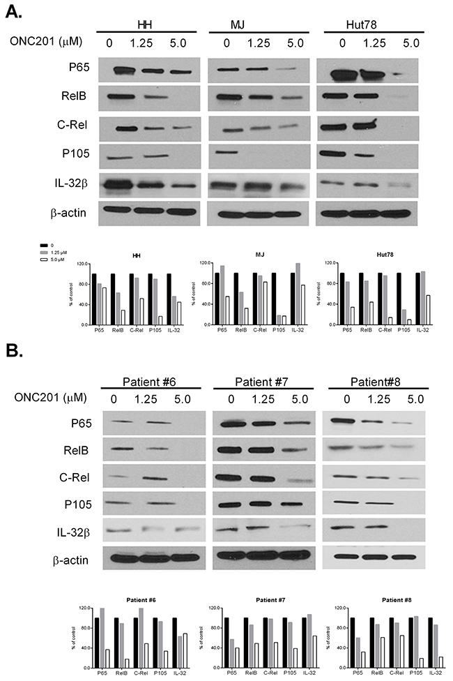 ONC201 downregulates NF-&#x03BA;B and IL-32 expression in CTCL cell lines and primary S&#x00E9;zary cells.