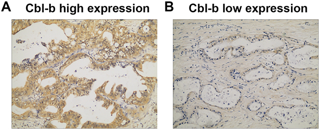 Cbl-b expression in PDAC tissue assayed by immunohistochemistry.