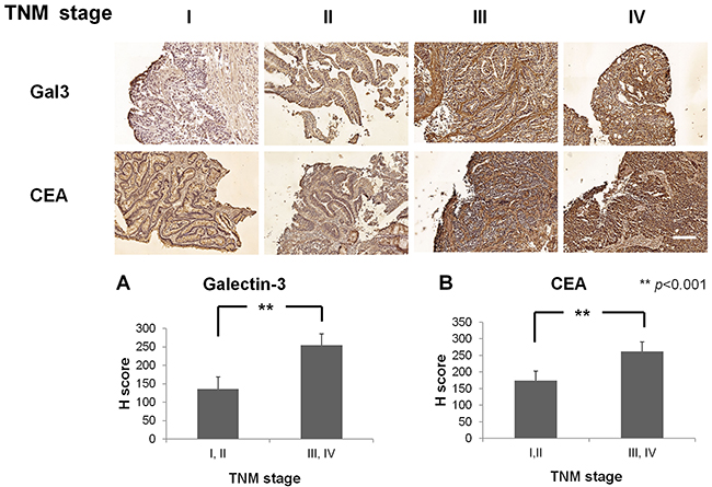 Immunohistochemical staining of CRC patient samples with Gal3 and CEA.