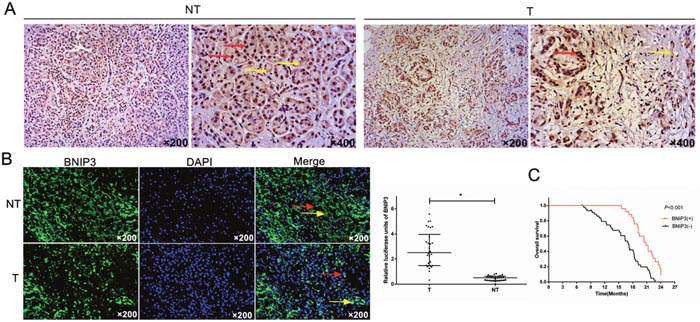 Expression analysis of BNIP3 in pancreatic tumors and prognostic value in pancreatic cancer.