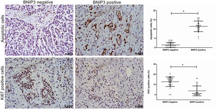 Correlation of BNIP3 expression with proliferation and apoptosis in pancreatic cancer tissues.