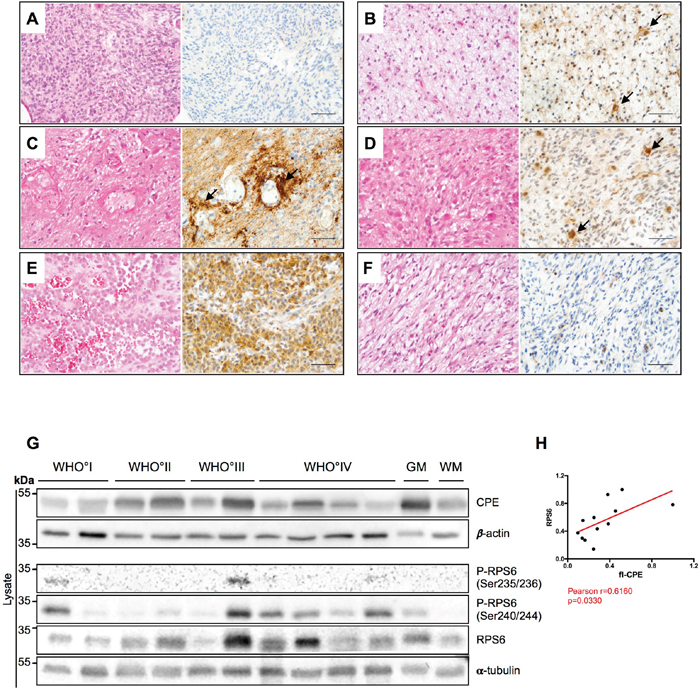 CPE is heterogeneously expressed in human gliomas.