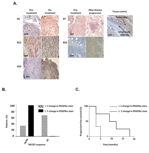 PDGFR&#x3b1; expression in melanoma metastases obtained from patients who acquired BRAF-I resistance.
