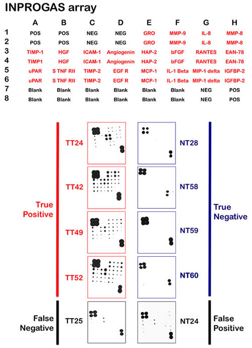 Figure 4:Classification and prediction of GC diagnosis using INPROGAS.