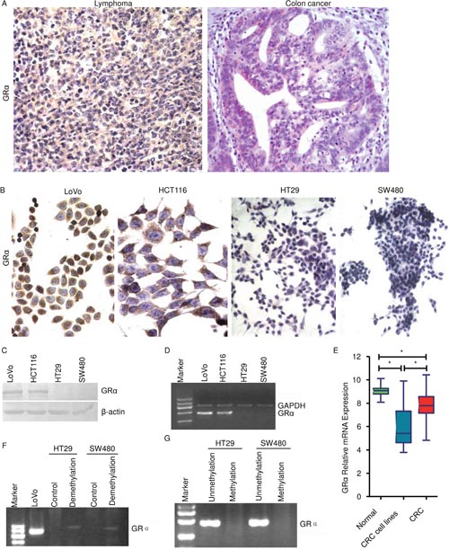 Colon cancer expresses dramatic lower GR&alpha; than lymphoma.