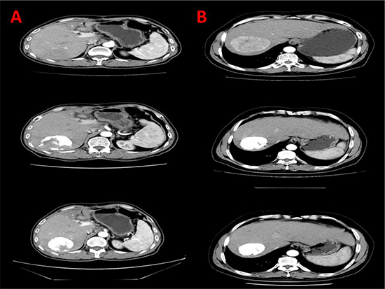 CT scans depiction of lipiodol deposition in TACE alone and TACE + sorafenib group.