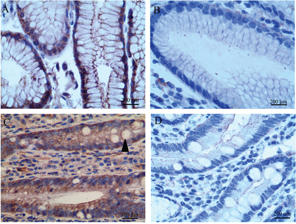 LGR5 expression in tissues adjacent to gastric carcinoma (GC).