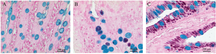 The classification of gastric intestinal metaplasia (GIM) with high iron diamine-alcian blue staining (HIDAB).