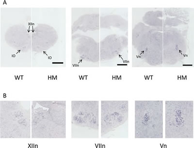 Absence of abnormalities of the brainstem nuclei expressing