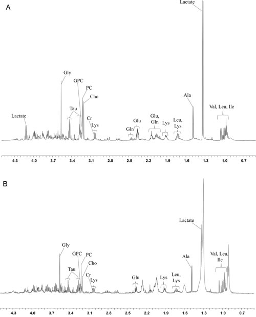 The HR-MAS MR spectra (11.7T) obtained using core needle biopsy specimens show the peaks of each metabolite.
