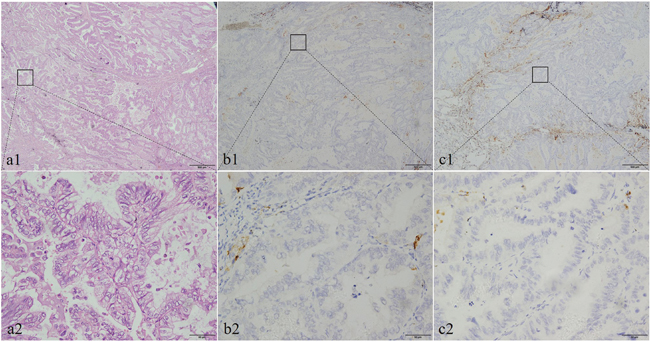 The histological morphology and the immunohistochemical expression of CDH17 and SATB2 in pulmonary enteric adenocarcinoma (PEAC).