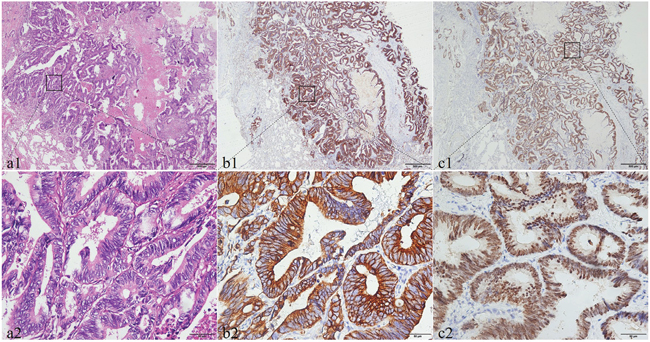 The histological morphology and the immunohistochemical expression of CDH17 and SATB2 in pulmonary metastatic colorectal adenocarcinoma.