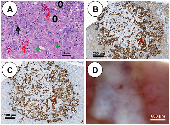 pHCC intrahepatic xenografted tumors recapitulate cytologic and histologic features of human HCC.