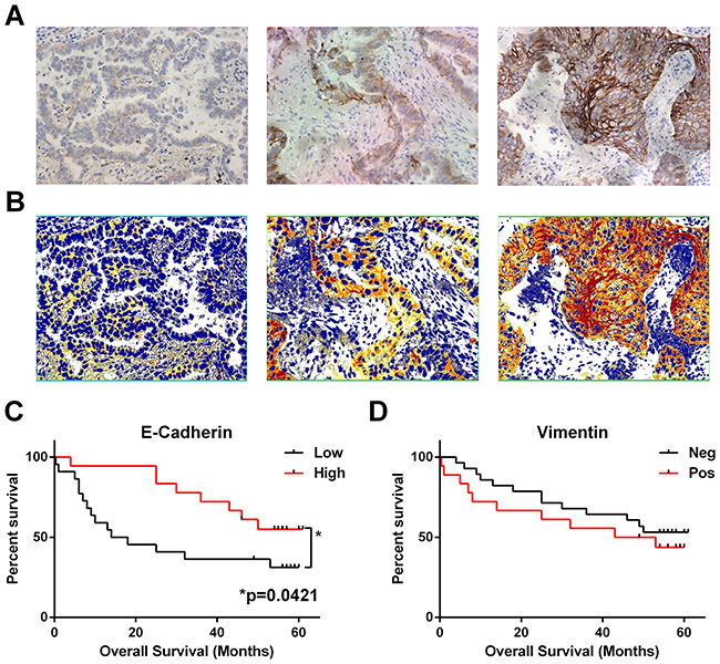 Loss of epithelial marker E-cadherin correlates with worse overall survival.