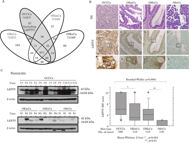 Up-regulation of LEFTY protein expression in OCCCa.