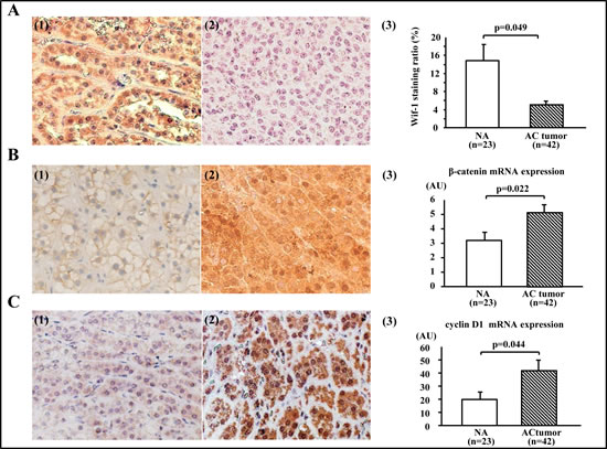 Expressions of Wif-1, &#x3b2;-catenin, and cyclin D1 in adrenocortical tumors.