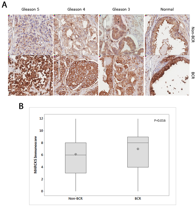 MARCKS staining in non-BCR and BCR cohorts.