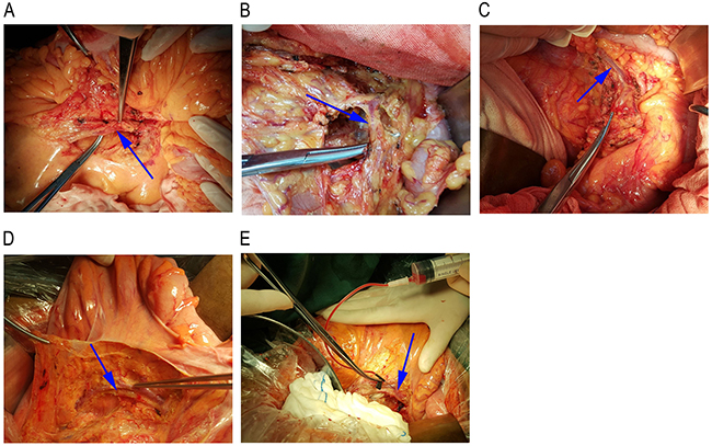 First reflux vein blood collection position.