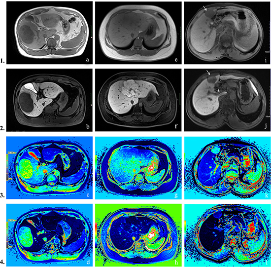 Row 1: pre-contrast T1-weighted images, Row 2: hepatobiliary phase images, Row 3: pre-contrast T1 mapping images, Row 4: hepatobiliary phase T1 mapping images.