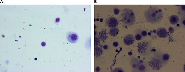 Representative H&#x0026;E stained photographs of alveolar macrophages undergoing apoptosis as observed underlight microscope (1000&#x00D7;).