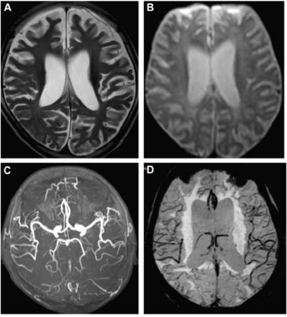 MR images of the RTT patient.