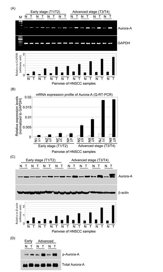 The expression levels of mRNA and protein and activity of Aurora-A are increased in advanced stage of HNSCC clinical samples.