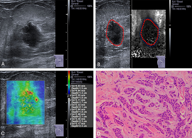 Conventional US and ARFI elastography of a 83-year-old female patient.