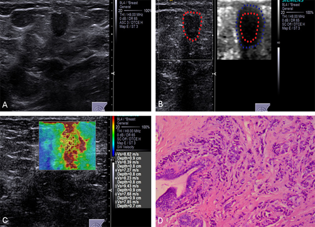 Conventional US and ARFI elastography of a 63-year-old female patient.