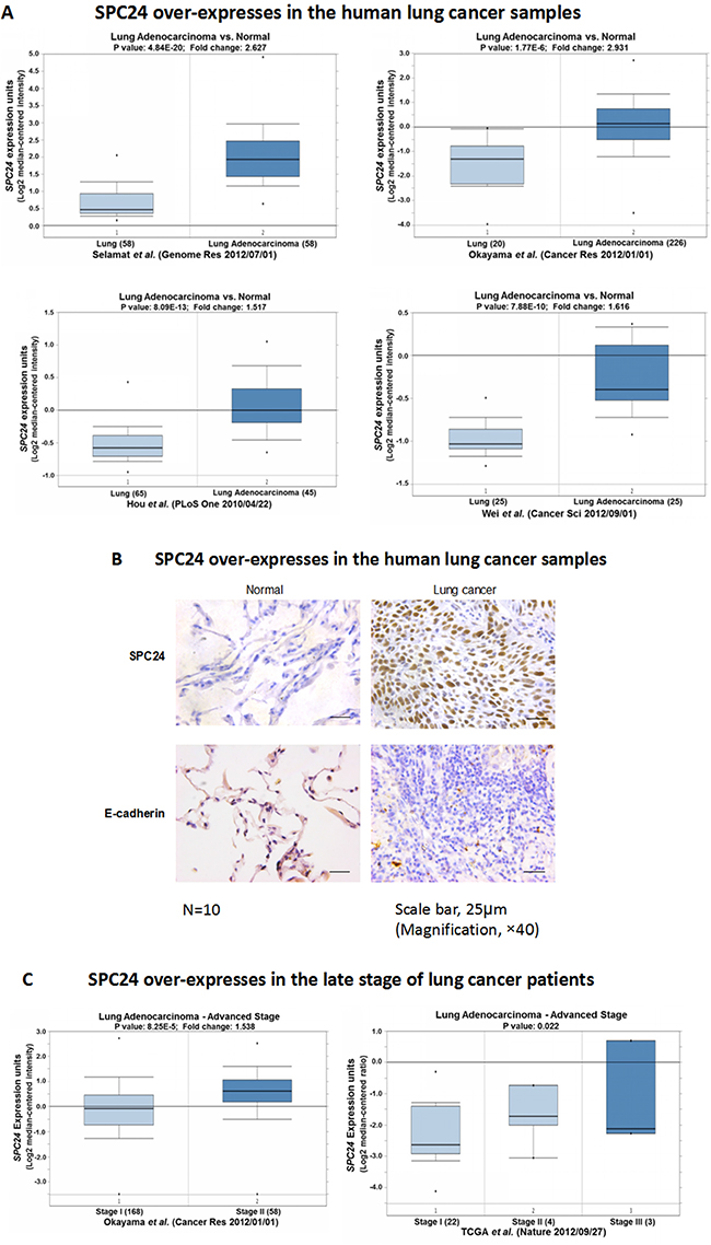 SPC24 is over-expressed in human lung adenocarcinoma tumors.