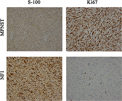 Protein Expression of S-100 and Ki67: in MPNSTs and NF1 (200X), separately.