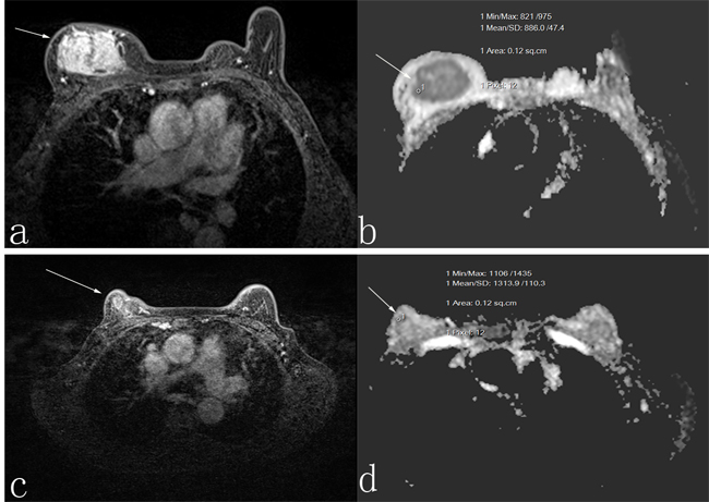 A 50-year-old woman who was responder with invasive ductal carcinoma.