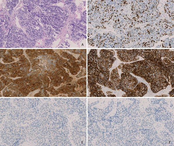 Immunohistochemistry for liver cancers with stem/progenitor cell features.