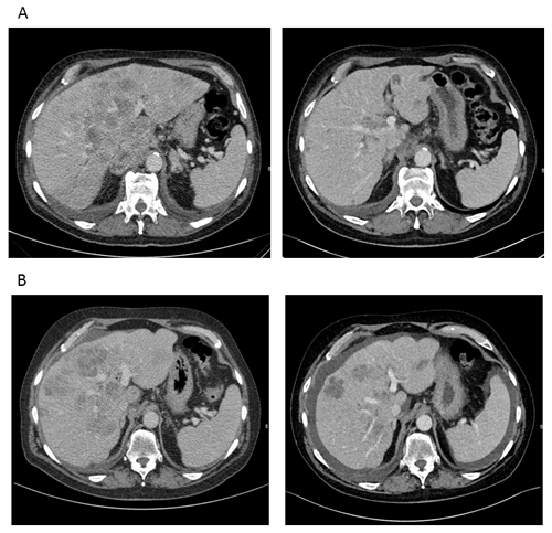 CT-scans reveal a marked response to therapy until the fourth line of treatment (patient 1).