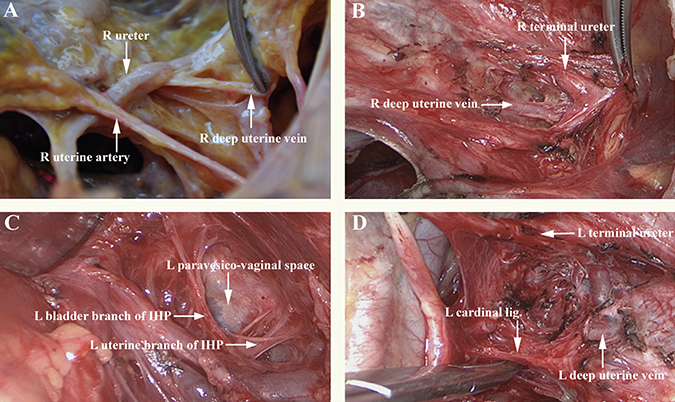 Anatomic relationship between the paravesico-vaginal space and the deep uterine vein.