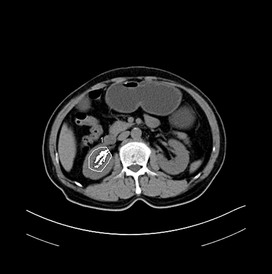 Representative axial CT image showing renal sinus fat area.